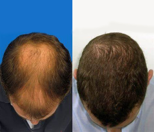 زراعة الشعر قبل وبعد - المميزات