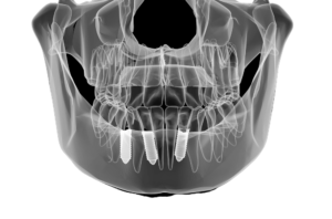 زراعة الأسنان صورة شعاعية
