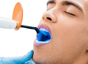 طريقة تبييض الأسنان