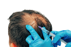 إجراء زراعة الشعر