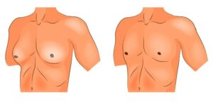 نتائج عملية تصغير الثدي عند الرجال