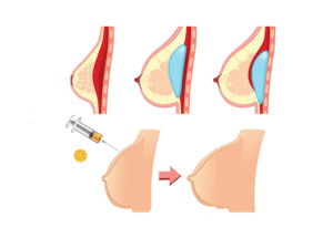 مقارنة بين تكبير الثدي بالحشوات وحقن الدهون في الثدي