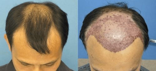 زراعة الشعر في تركيا.10 حقائق مهمة