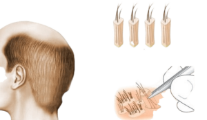 طريقة زراعة الشعر بتقنية الاقتطاف