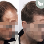 زراعة الشعر قبل وبعد – عيادة الدكتور إلكر أبايدين – رقم العملية: 1