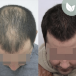 زراعة الشعر قبل وبعد – عيادة الدكتور إلكر أبايدين – رقم العملية: 2