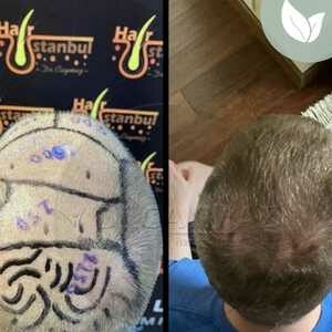 زراعة الشعر قبل وبعد – عيادة الدكتور إكرام كايمز - رقم العملية: 1