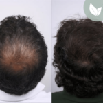 زراعة الشعر قبل وبعد – عيادة الدكتور إلكر أبايدين – رقم العملية: 8
