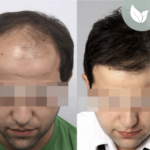 زراعة الشعر قبل وبعد – عيادة الدكتور إلكر أبايدين – رقم العملية: 7