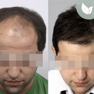 زراعة الشعر قبل وبعد – عيادة الدكتور إلكر أبايدين – رقم العملية: 7