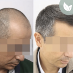 زراعة الشعر قبل وبعد – عيادة الدكتور إلكر أبايدين – رقم العملية: 6