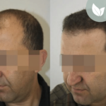 زراعة الشعر قبل وبعد – عيادة الدكتور إلكر أبايدين – رقم العملية: 5