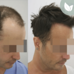 زراعة الشعر قبل وبعد – عيادة الدكتور إلكر أبايدين – رقم العملية: 4