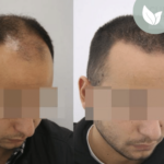 زراعة الشعر قبل وبعد – عيادة الدكتور إلكر أبايدين – رقم العملية: 3